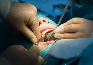 удаление зубов под наркозом